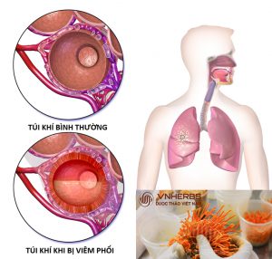 VNH Tac dung dong trung ha thao voi benh viem phoi
